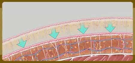 Vaser Liposuction in Bangkok, Thailand