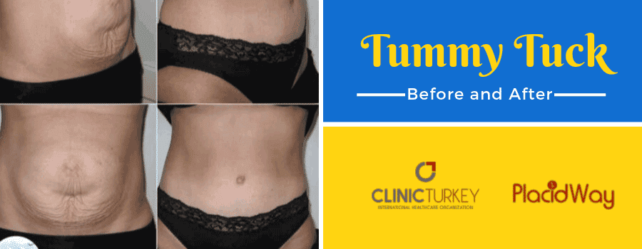 Before and After Tummy Tuck in Izmir, Turkey