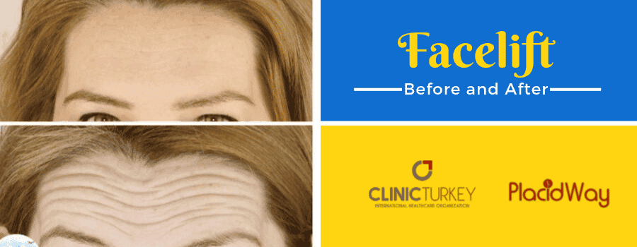 Face Lift Before and After in Turkey