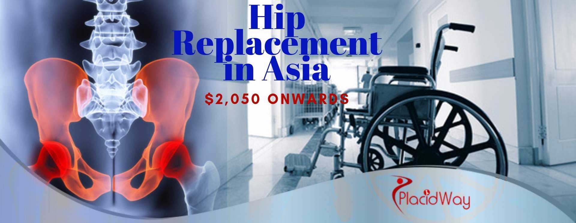 Cost Hip Replacement in Asia