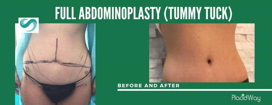 Tummy Tuck Before and After in Turkey