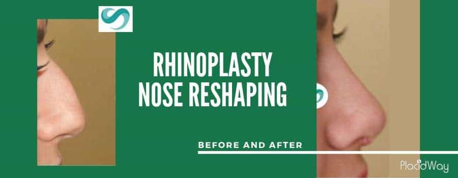 Rhinoplasty Before and After in Turkey