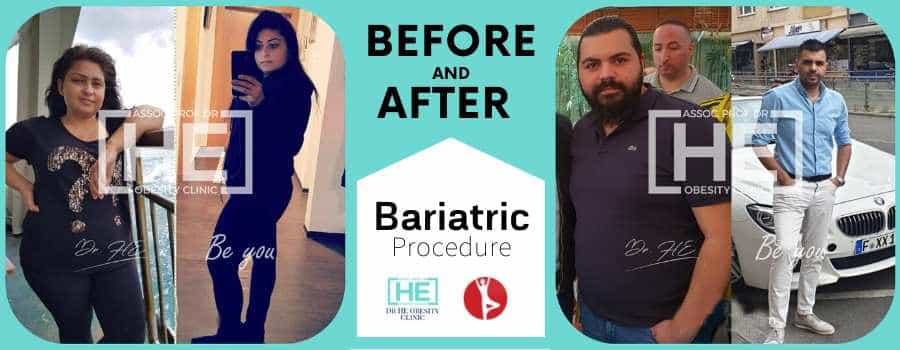Before and After weight loss Surgery in Istanbul, Turkey - Dr HE Clinic
