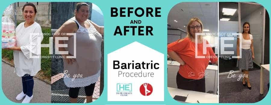 Before and After Bariatric Surgery in Istanbul, Turkey - Dr HE Clinic