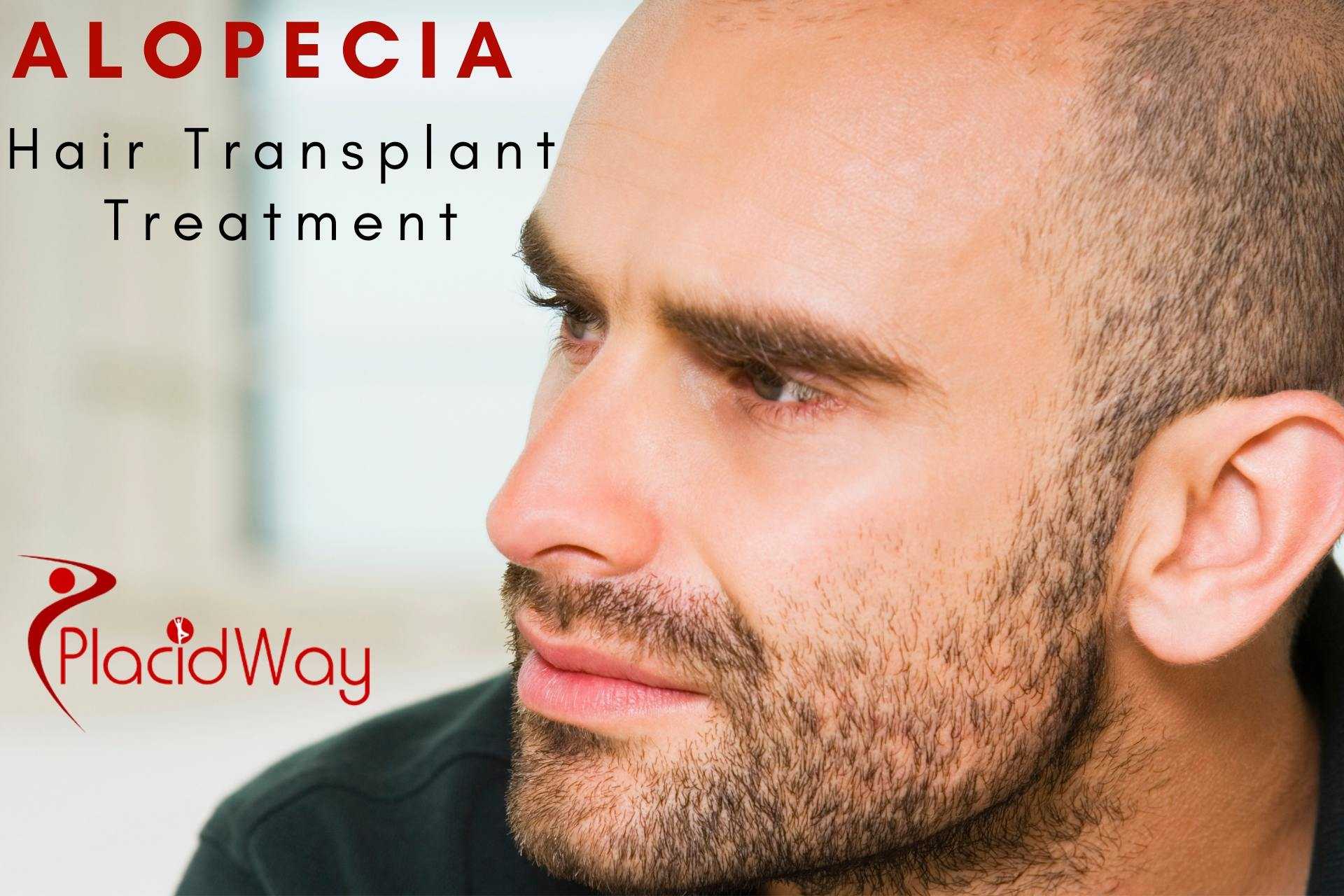 Alopecia Hair Transplant Treatment