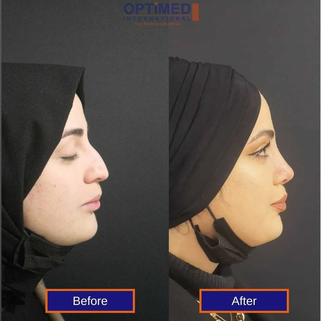 Before and after Rhinoplasty in Turkey