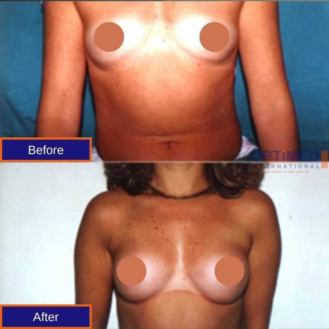 before and after Breast Lift in Turkey