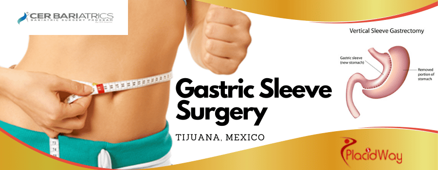 Gastric Sleeve Tijuana Mexico