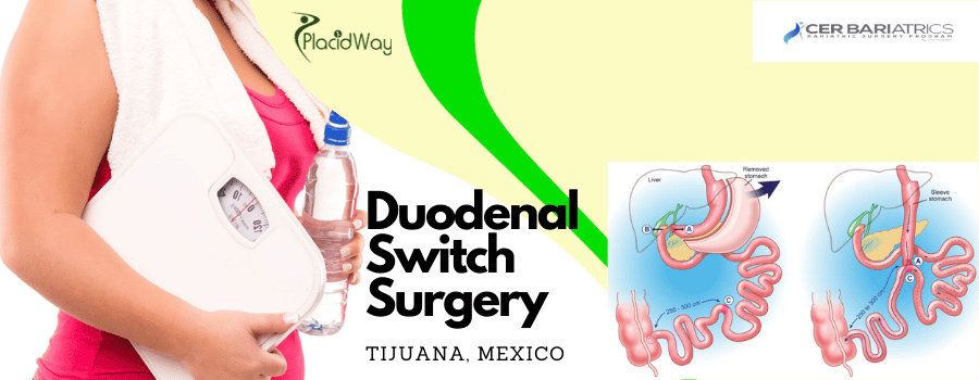 Duodenal Switch Surgery in Tijuana, Mexico