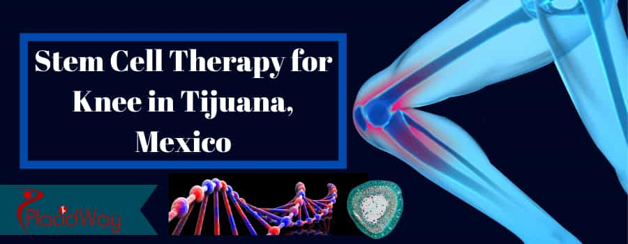 Stem Cell Therapy for Knee in Tijuana Mexico