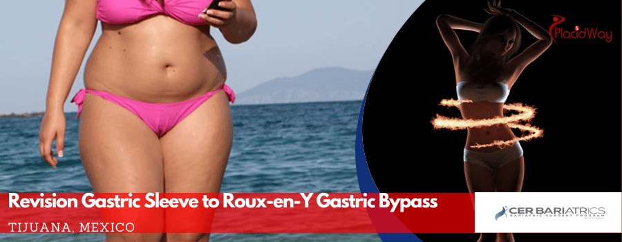 Gastric Sleeve Revision Mexico