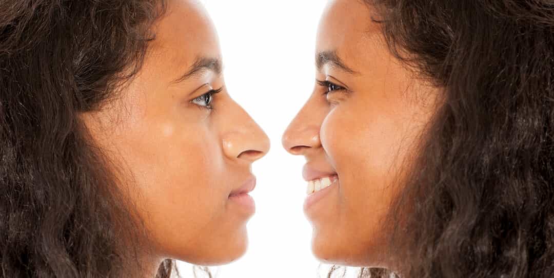 Rhinoplasty