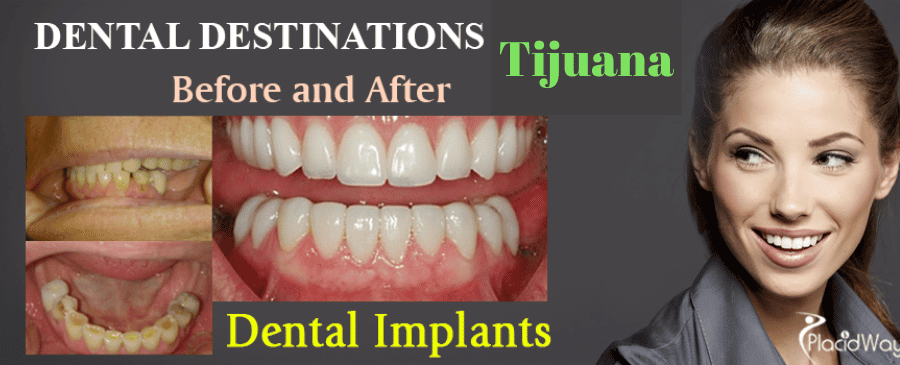 Before and After Dental Implants in Tijuana Mexico