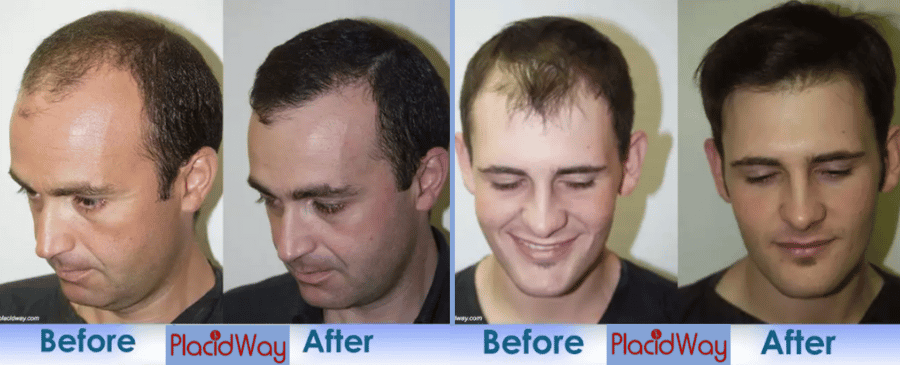 before and after hair transplant in Istanbul Turkey