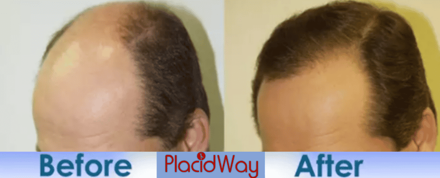 hair transplant before and after in Istanbul Turkey