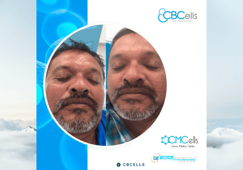 Stem Cell Clinic In Mexico