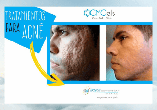 Stem Cell Clinic In Mexico