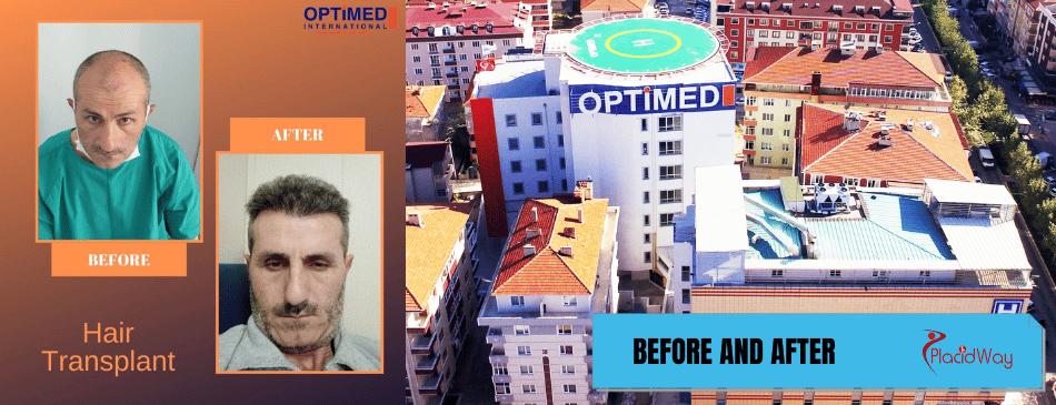 Before and After Hair Transplant in Istanbul Turkey at Optimed Hospital