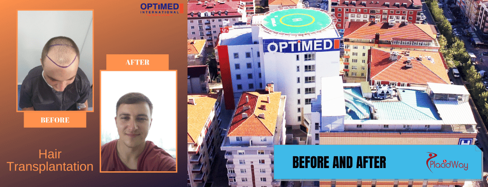 Before and After Hair Transplant in Istanbul Turkey at Optimed Hospital