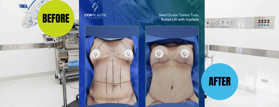 Before and After Results of Breast Augmentation in Tijuana Mexico