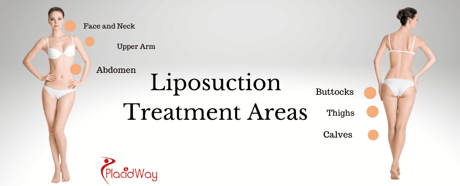 Liposuction treating areas