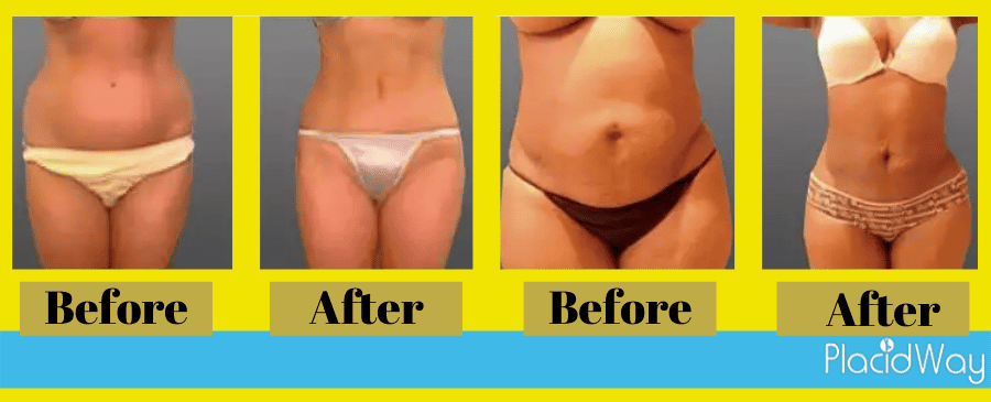 liposculpture before and after