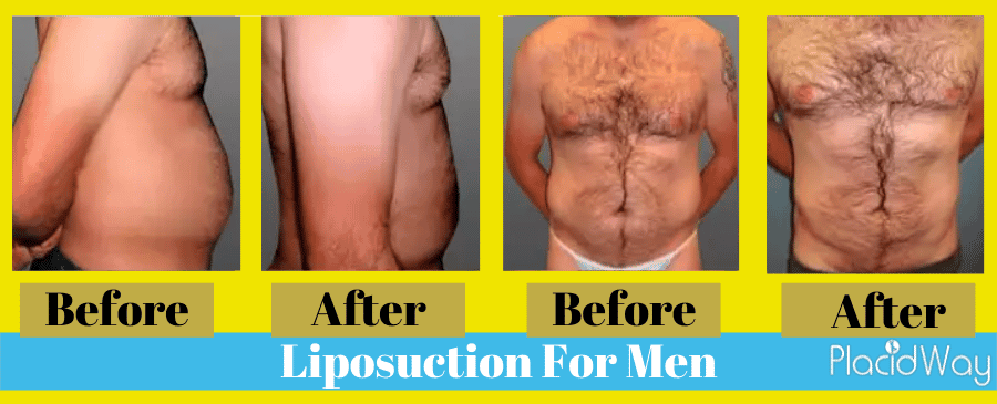 liposuction before and after male Colombia