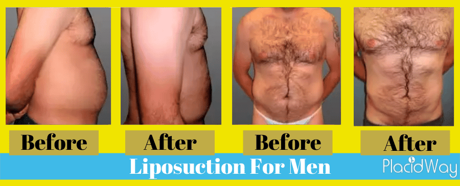 liposuction before and after male Colombia