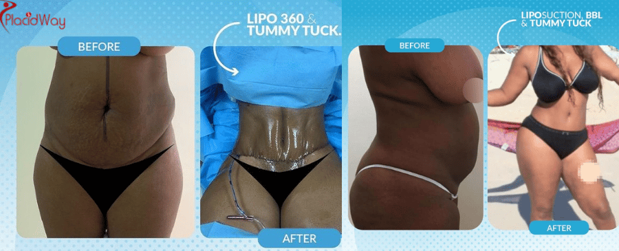liposuction in dominican republic before and after