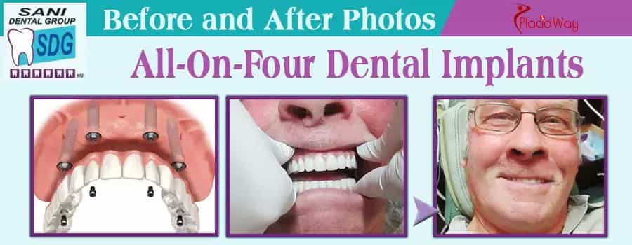 Before and After Full Mouth Dental Implants in Mexico