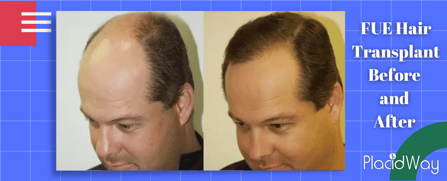 Before and After FUE hair Transplant in Mexico city