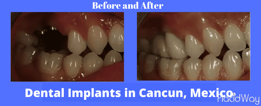  Before and after Dental Implants in Cancun Mexico