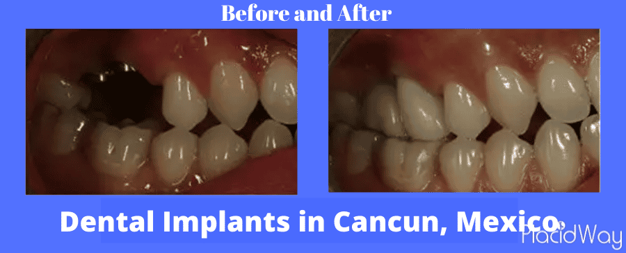  Before and after Dental Implants in Cancun Mexico