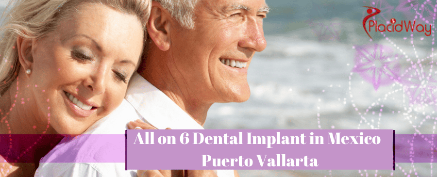 All on 6 Dental Implants in Puerto Vallarta, Mexico
