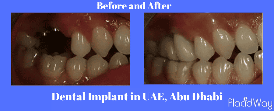  Before and After Dental Implants in UAE