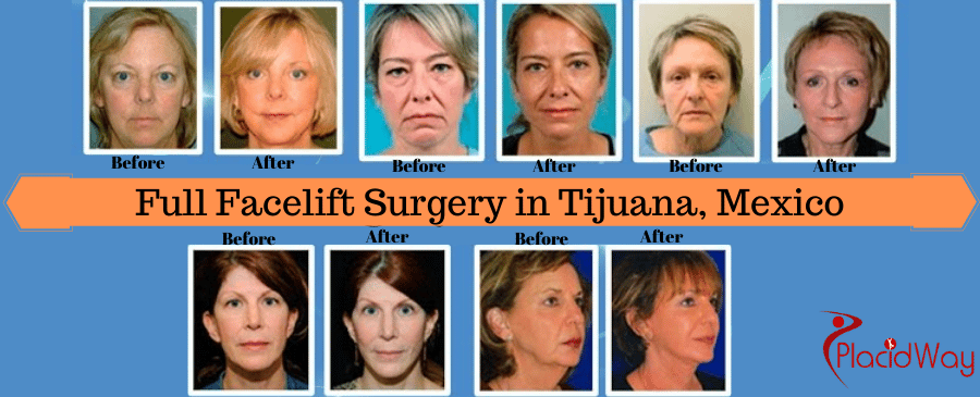 before and after full facelift in Tijuana Mexico