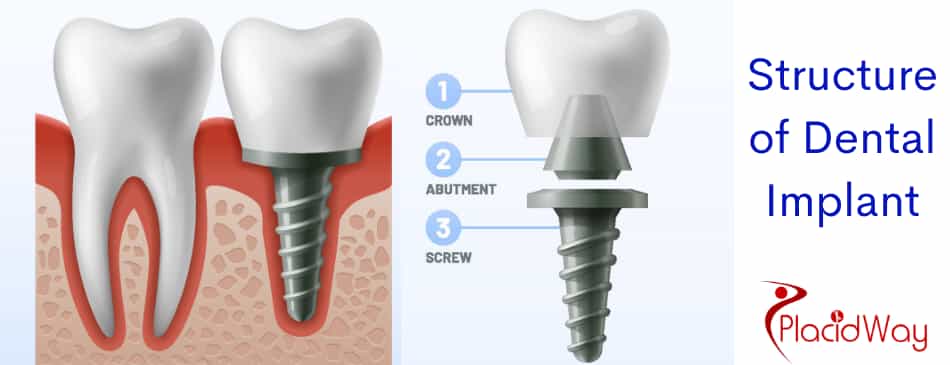 Structure of dental implants