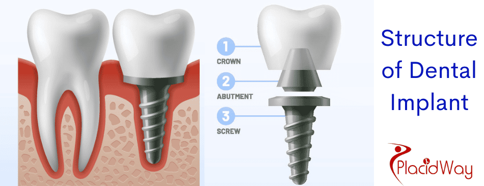 Dental implants in Turkey