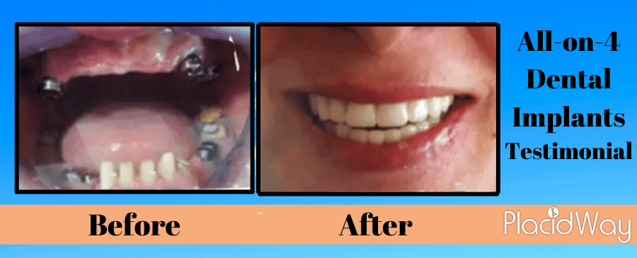 before and after dental implants results Istanbul, turkey