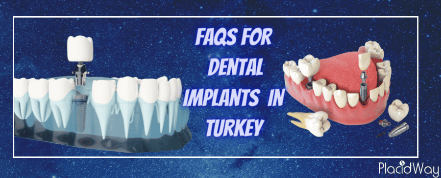 FAQs for Dental Implants in Turkey