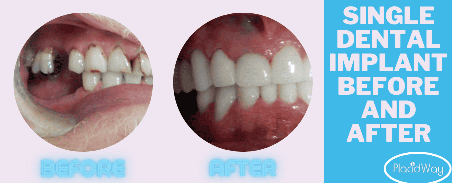Single Dental Implant Turkey Before and After