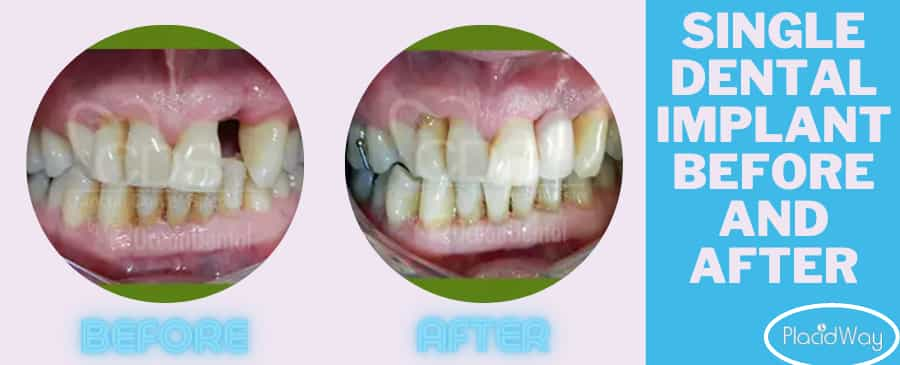 Before and After Dental Implant