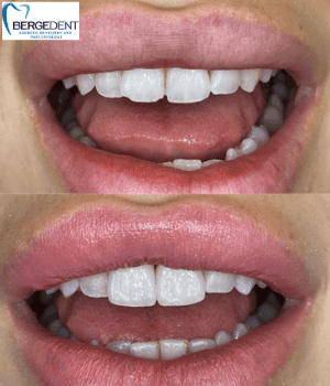 Laminate Veneers