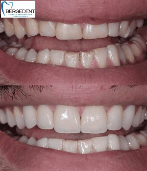 Ceramic Veneers and Teeth Whitening
