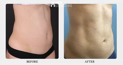 Hi Definition Liposuction Before and After