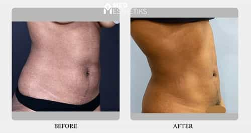 Hi Definition Liposuction Before and After