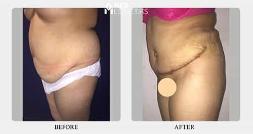 Tummy Tuck Before and After