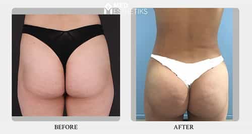 Buttock Augmentation Before and After
