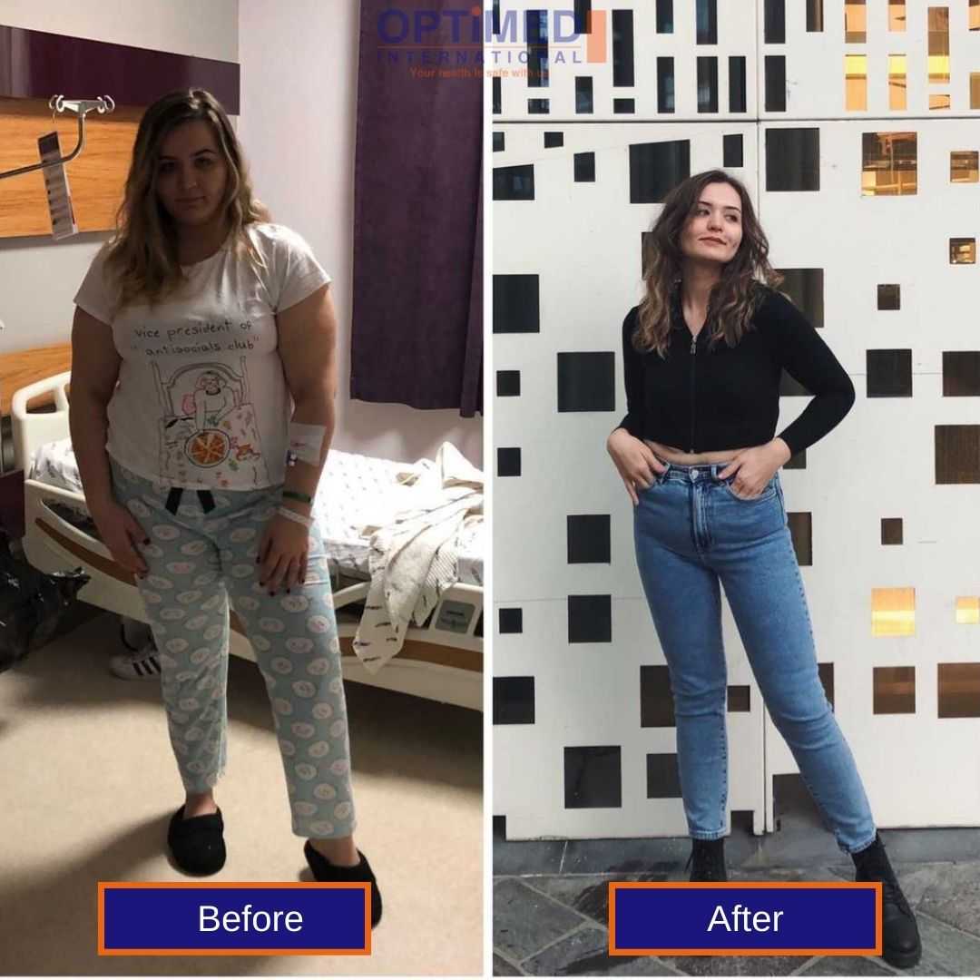 Before and after bariatric surgery in Turkey