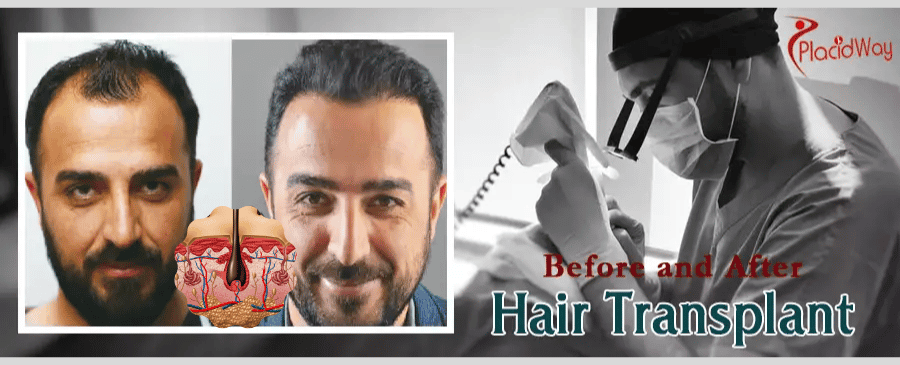 Hair Transplant Turkey Before and After